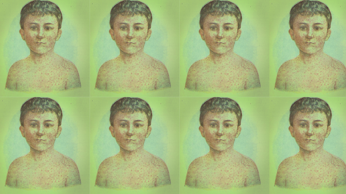 There has been a surge in measles this summer.